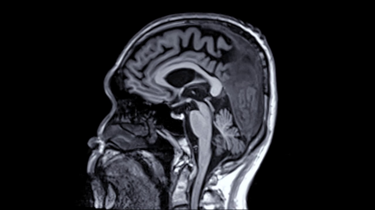 用钆造影剂做的大脑MRI。视频素材