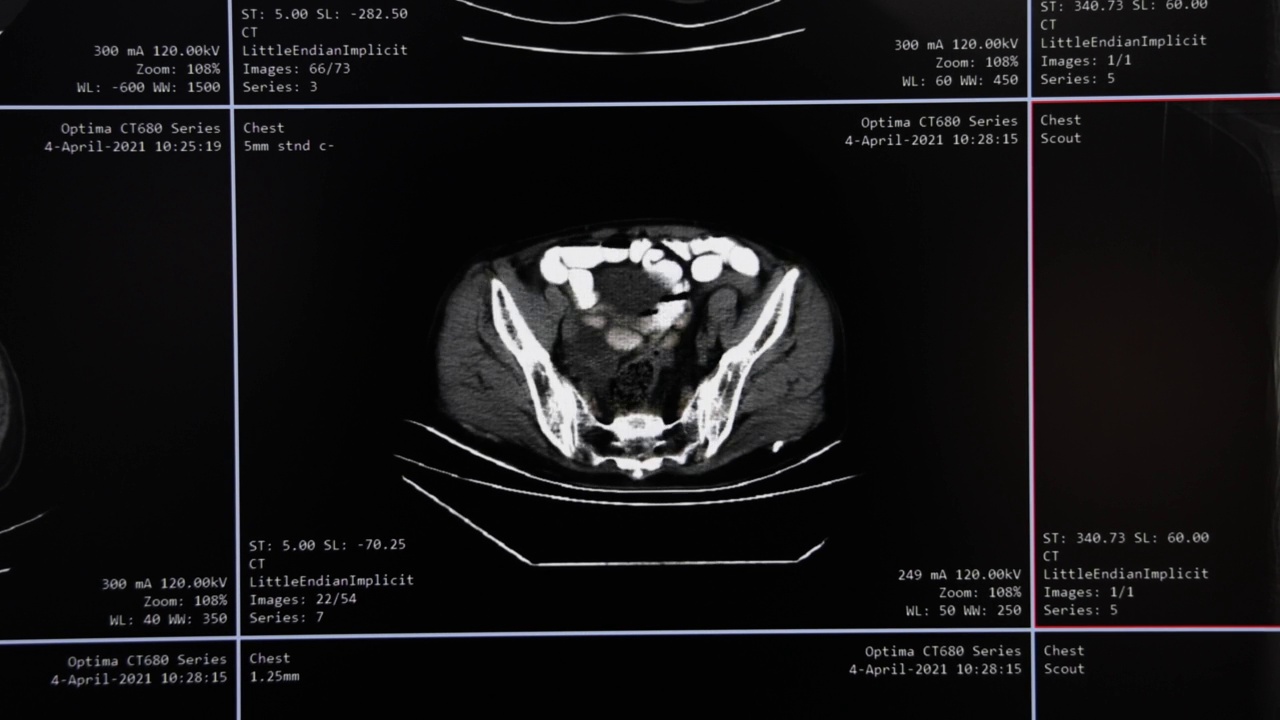 MRI腹腔断层扫描视频素材
