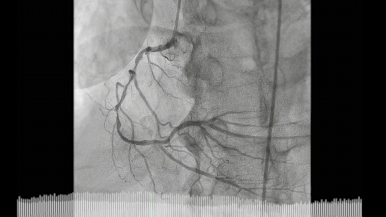 冠状动脉造影。视频素材