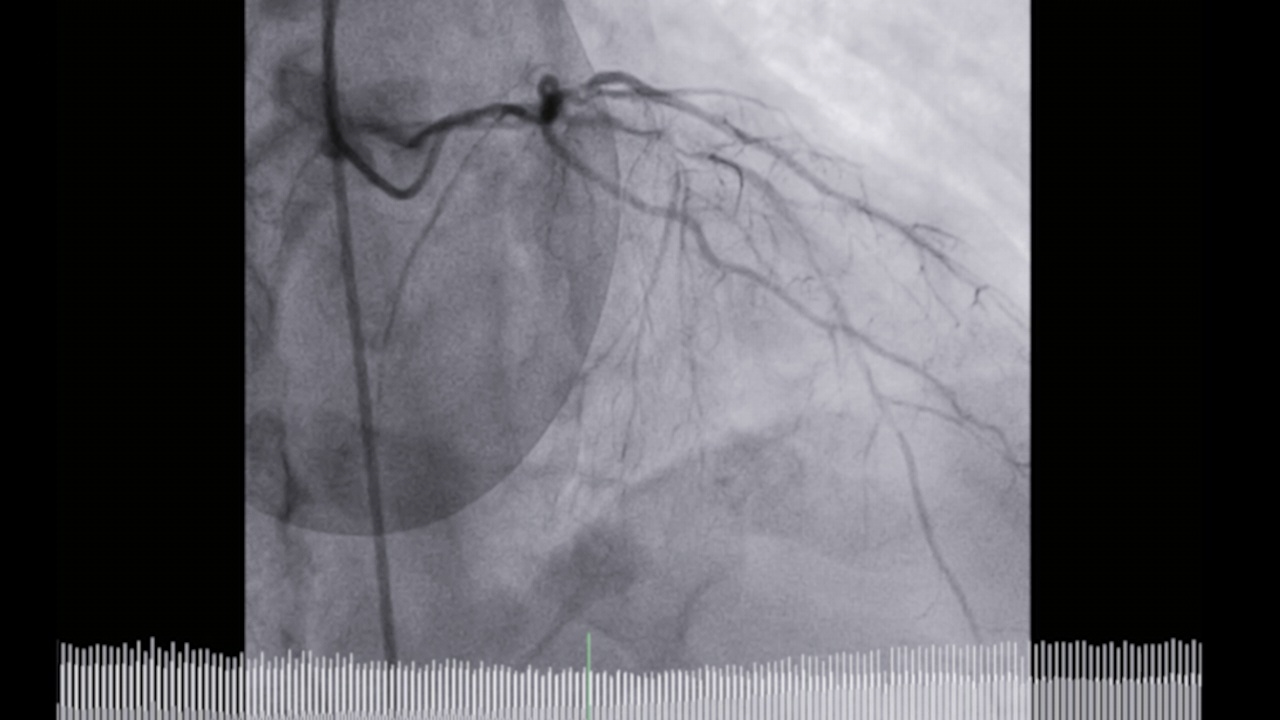 冠状动脉造影。视频素材