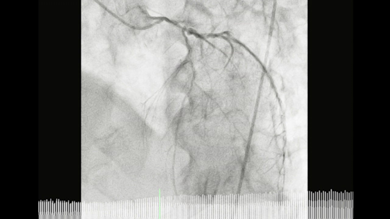 冠状动脉造影。视频素材