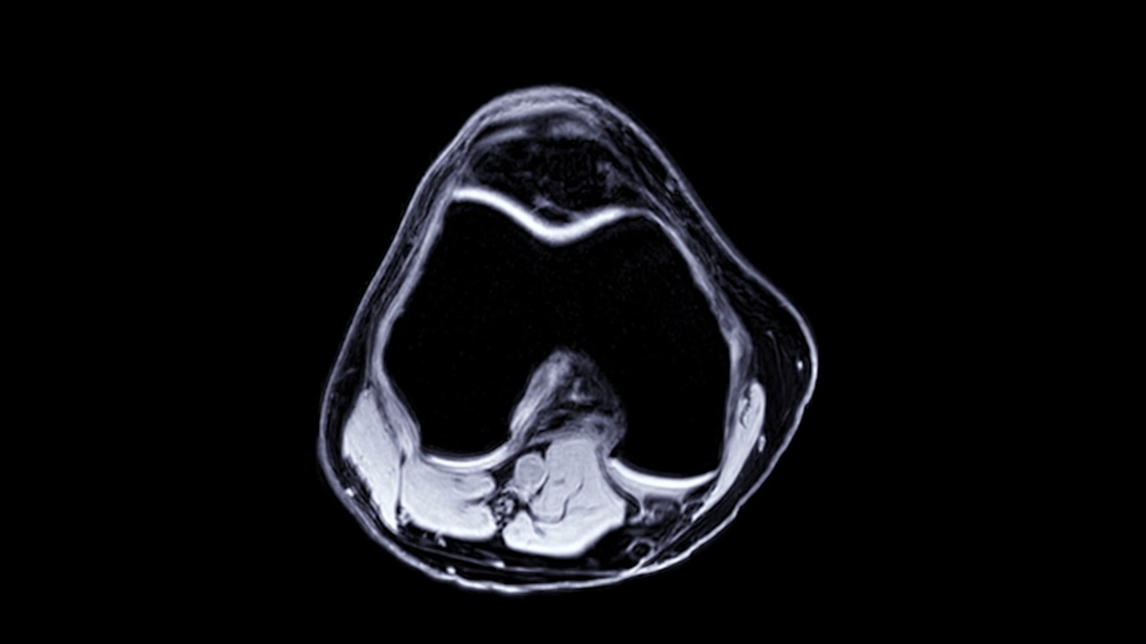 MRI膝关节。视频素材