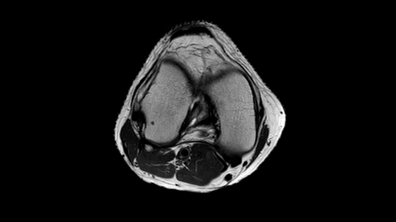MRI膝关节。视频素材