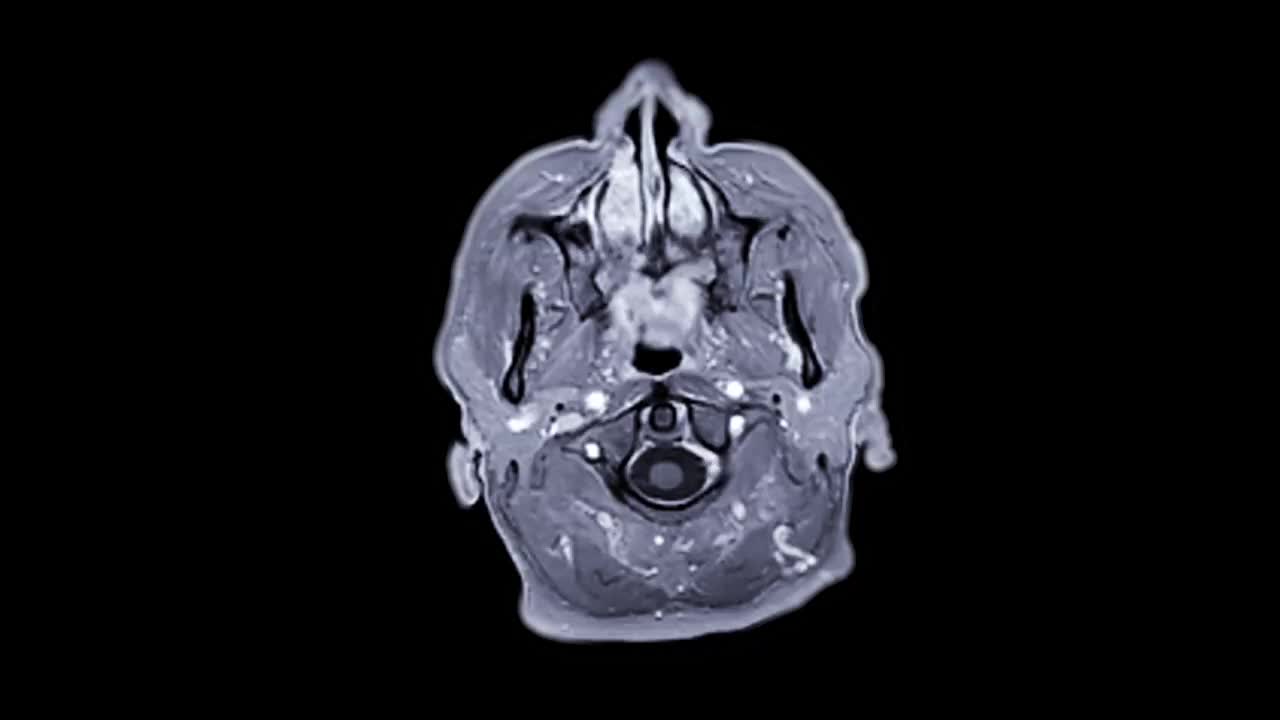 用钆造影剂做的大脑MRI。视频素材