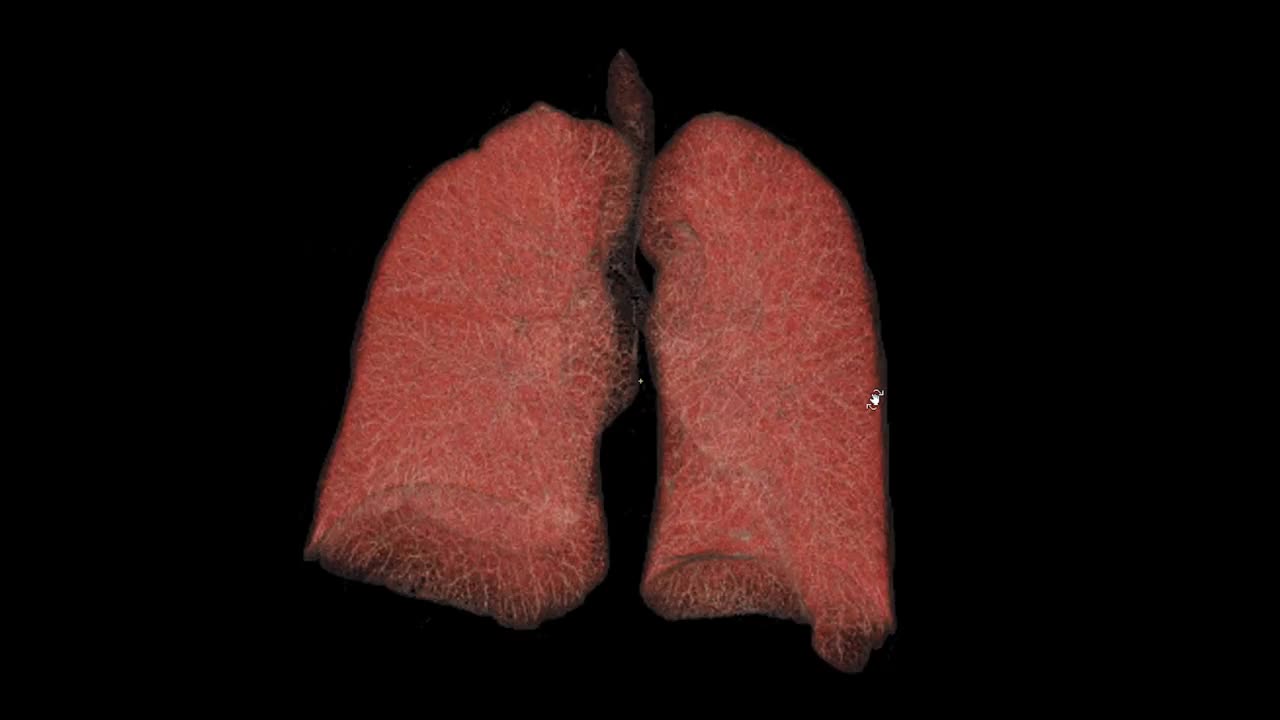 CT胸部或肺部3D渲染图像在屏幕上旋转。视频素材