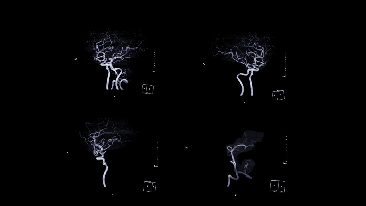 脑MRA或脑动脉磁共振血管造影。视频素材