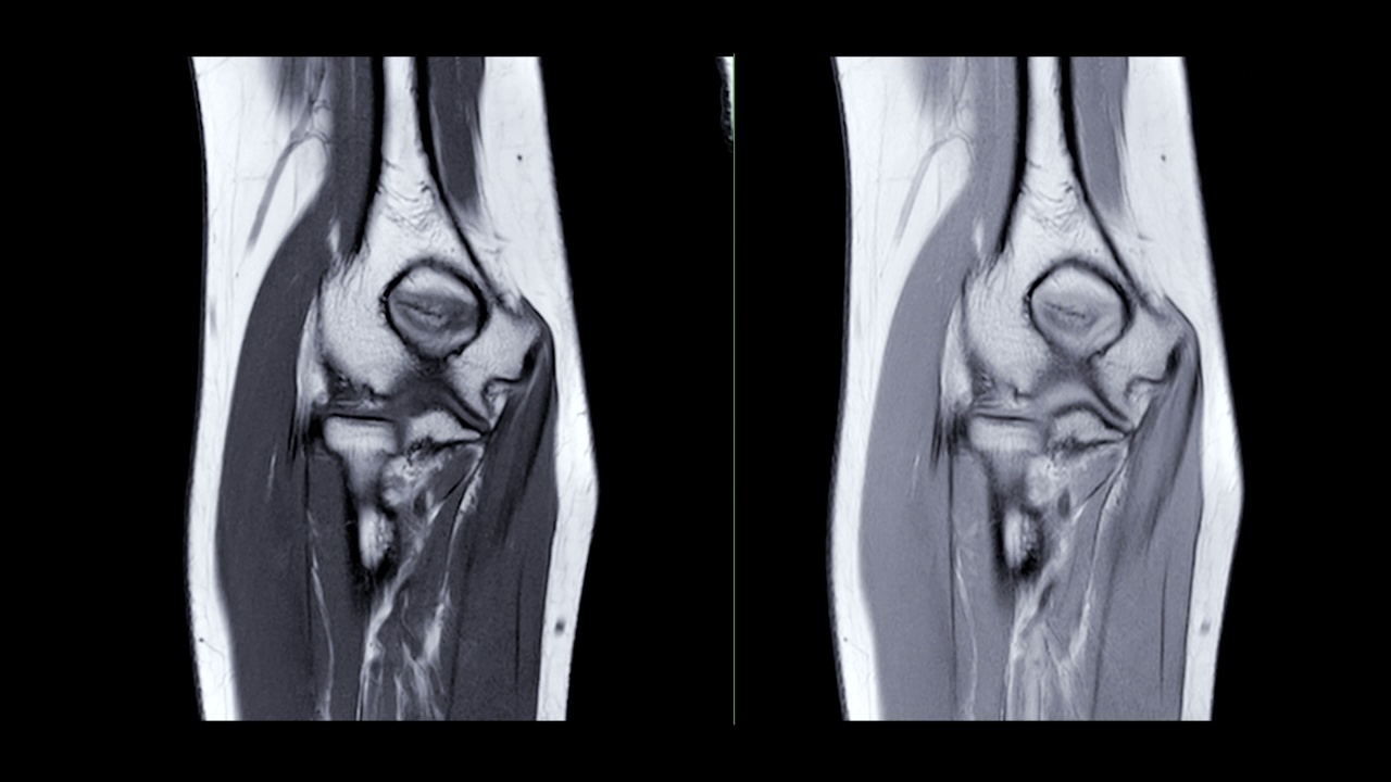 MRI肘关节。视频素材