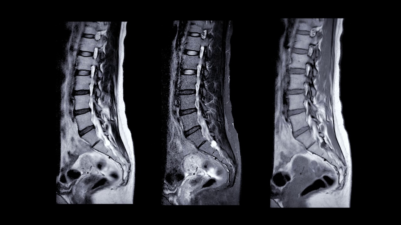 脊柱MRI条件下视频素材