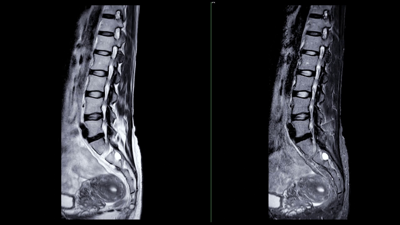 脊柱MRI条件下视频素材