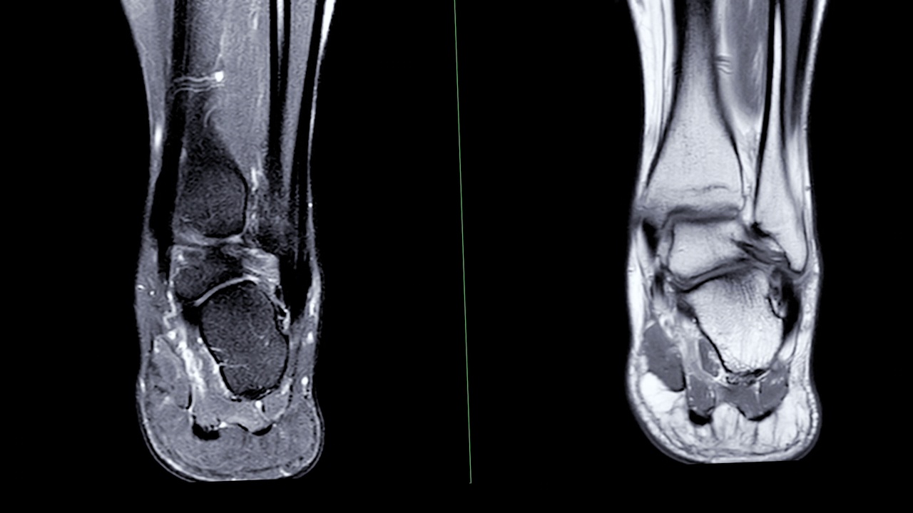 踝关节MRI。视频素材