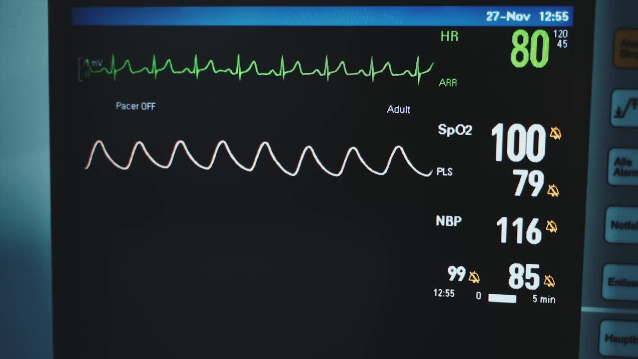 黑屏上有两条波浪线。监测手术病人的生命体征。关闭了。视频素材