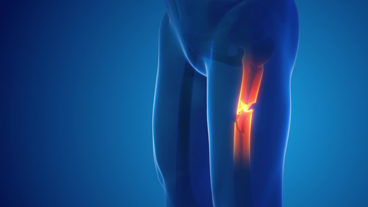 断腿股骨骨痛医学概念视频素材