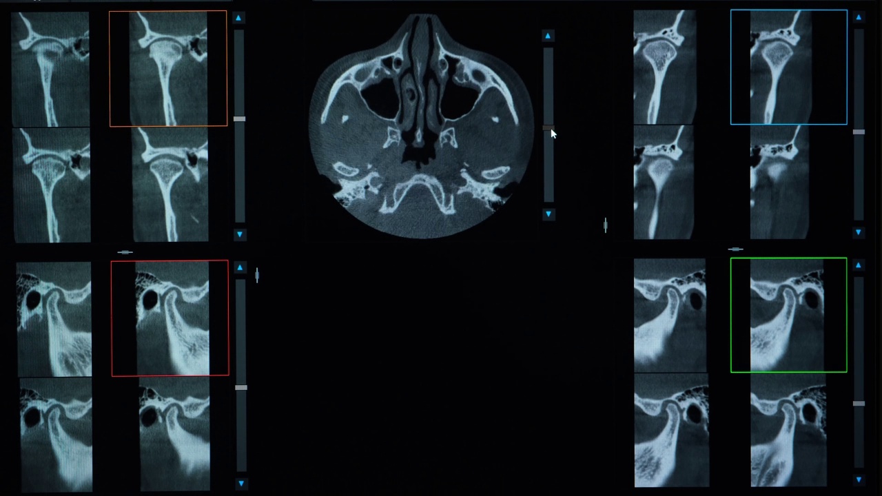 错咬合、缺牙和颞下颌关节功能障碍患者的CT扫描。视频素材
