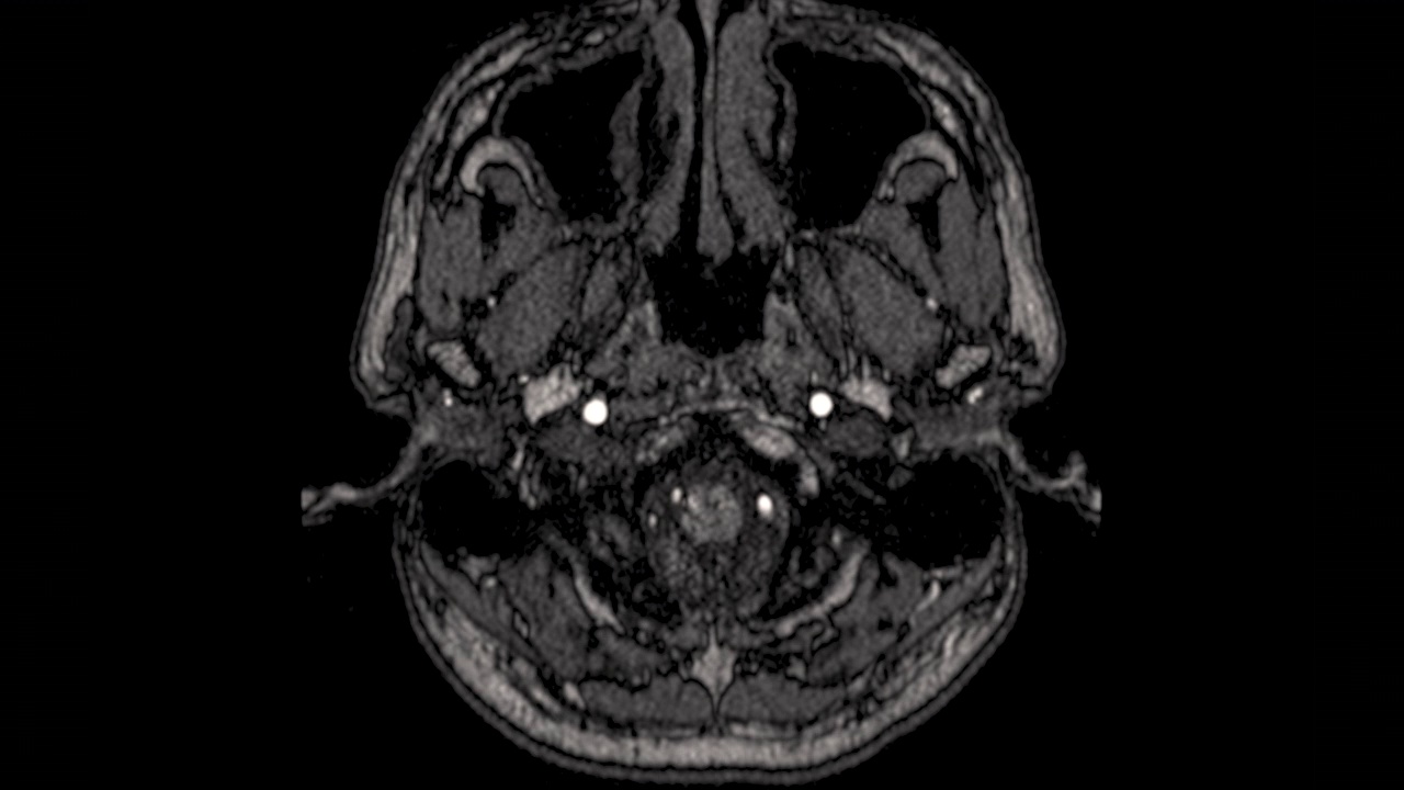 MRA脑或脑动脉磁共振血管造影视频素材