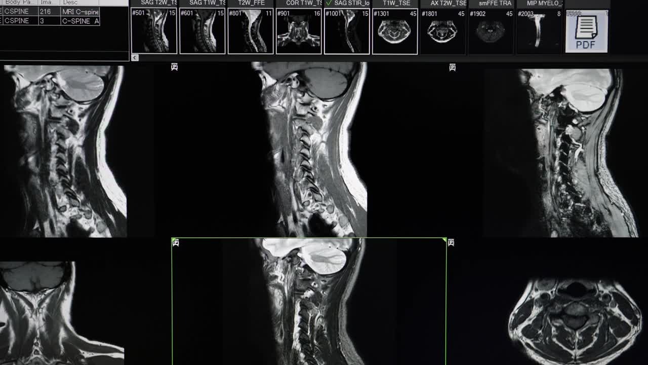 颈椎MRI扫描视频素材