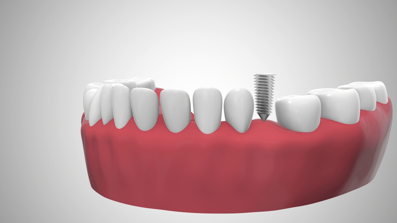 在牙龈中植入牙视频素材