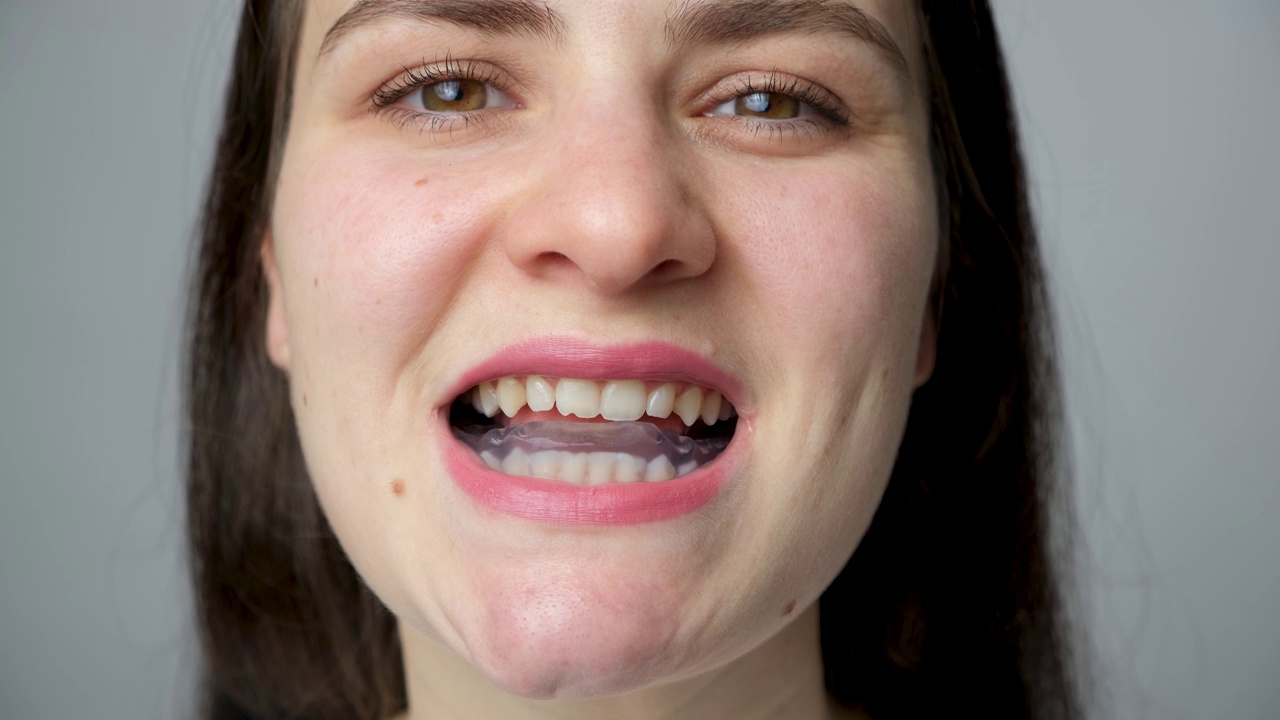 牙套、夹板在口腔内用于治疗颞下颌关节功能障碍、磨牙症、错颌，以放松下颌肌肉视频素材