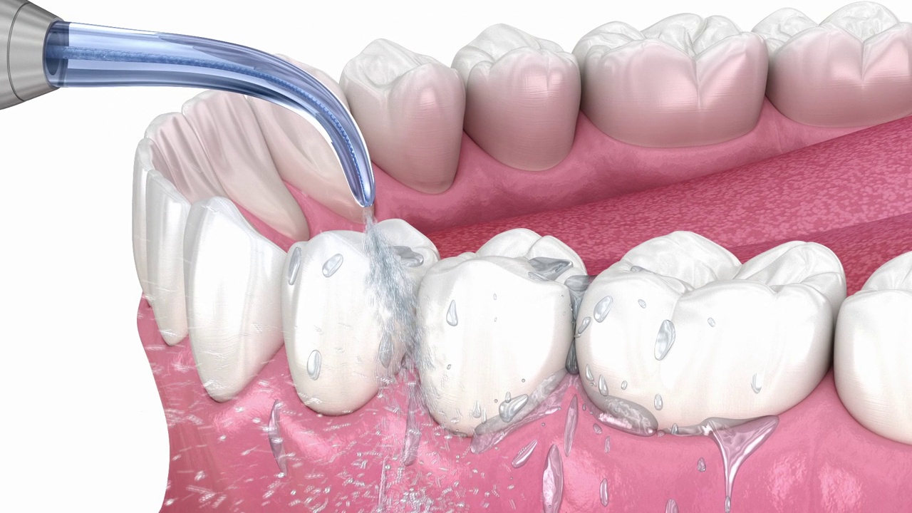 冲洗器，水清洗牙齿。医学上精确的口腔卫生3D动画。视频素材
