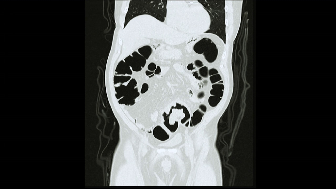 CT结肠镜冠状面。视频素材