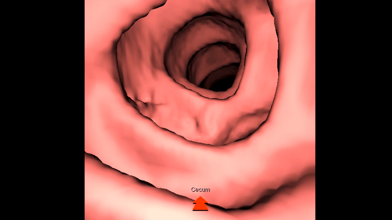 CT结肠显像3D显示。视频素材