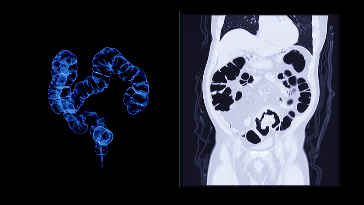 CT结肠显像3D显示。视频素材