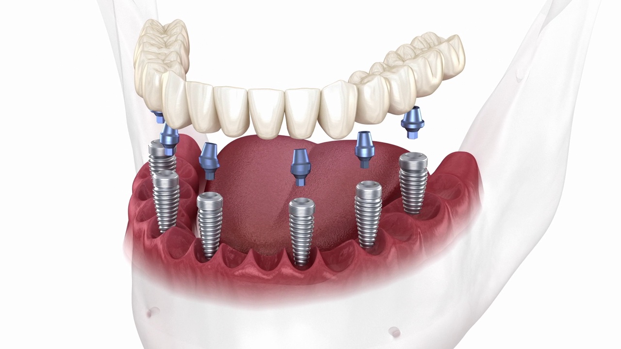 可拆卸的下颌骨假体全部在6系统上，由植入物支持。医学上精确的人类牙齿和假牙的3D动画视频素材