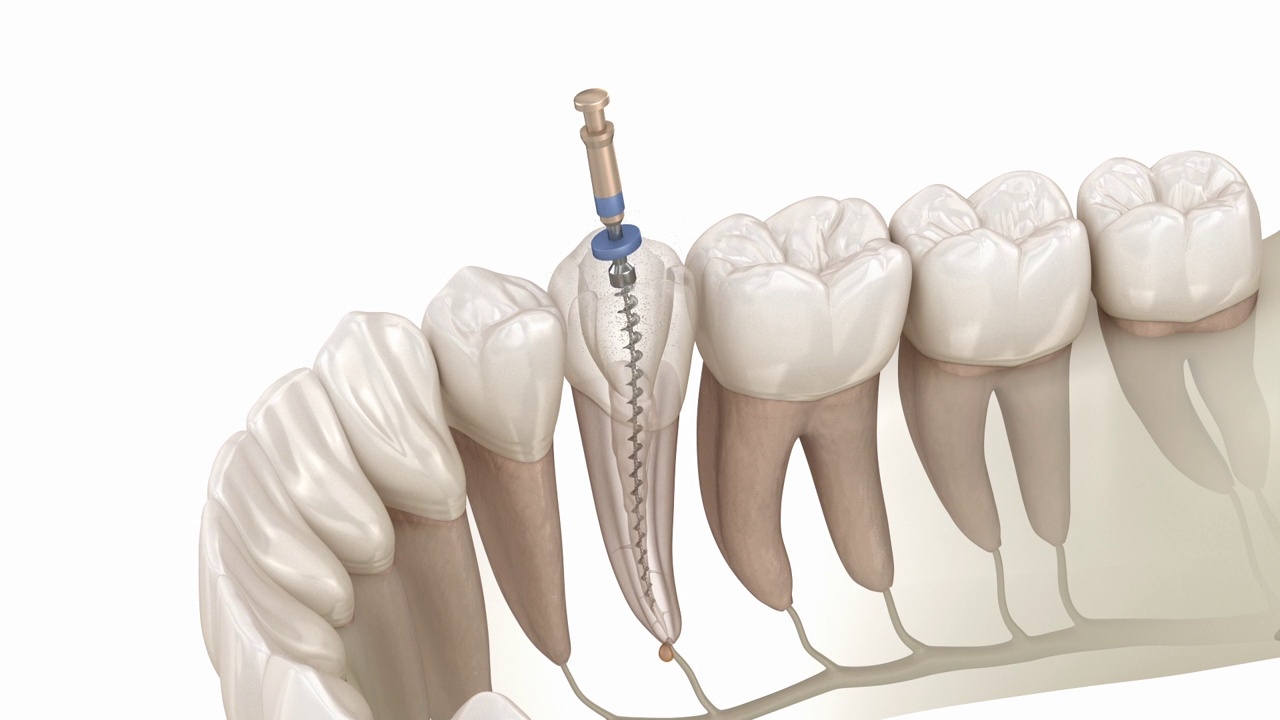 根管治疗过程。医学精确牙齿3D动画视频下载