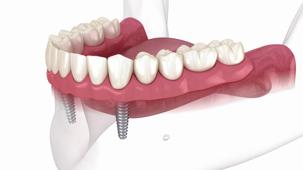 下颌骨可拆卸假体全2系统，由球状附件的植入物支持。医学精确牙科3D动画视频素材