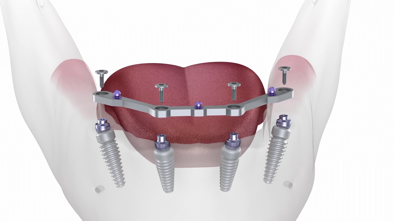 下颌假体带牙龈All on 4系统，种植体支持。医学精准3D动画视频素材