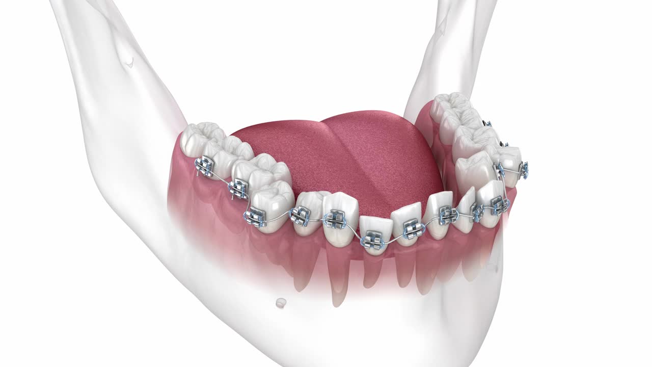 牙位异常及金属支具矫正治疗。医学精确牙科3D动画视频下载