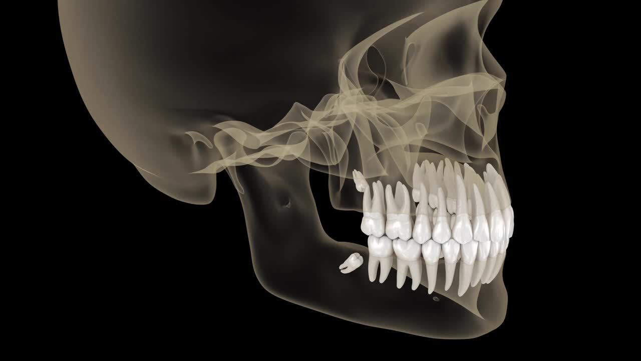 智齿嵌塞至第二臼齿。医学精确牙齿3d动画视频素材