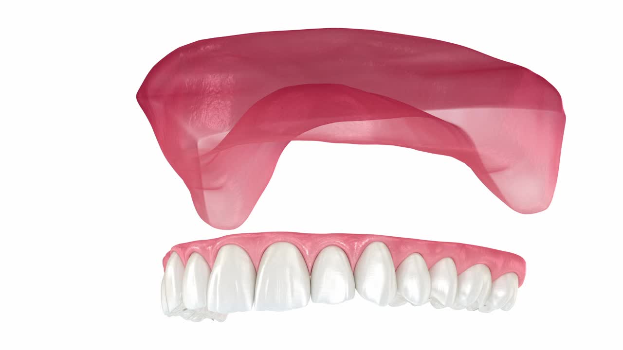上颌假体带牙龈All on 6系统由种植体支撑。牙科3D动画视频素材