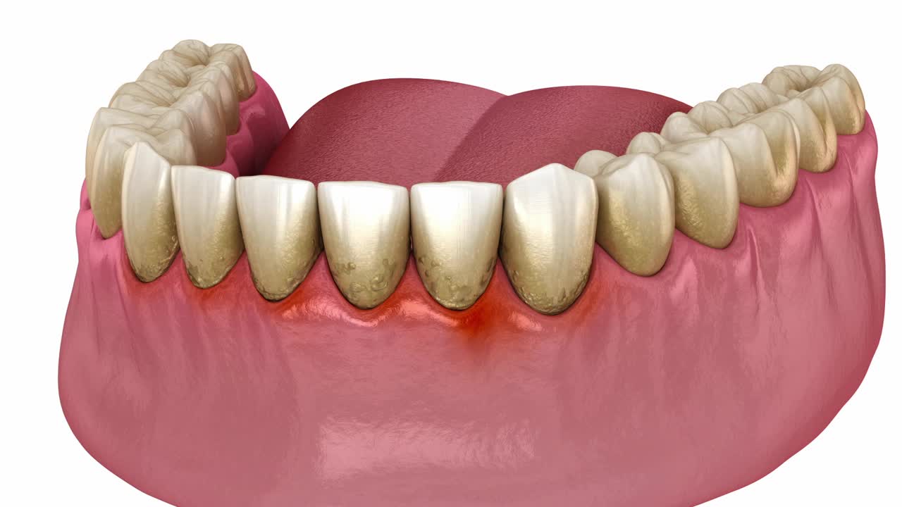 牙科洁牙(常规牙周治疗)。医学精准3D动画视频下载