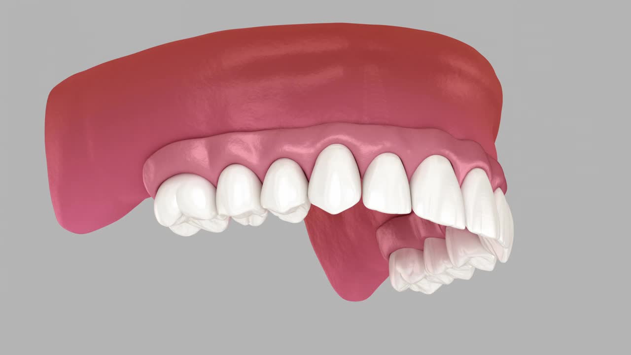 由四个植入物支撑的可移动假体。牙科3D动画视频素材
