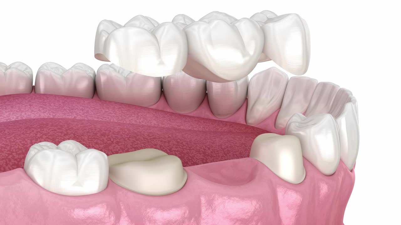 牙桥基于2颗牙齿。医学精准3D动画视频下载