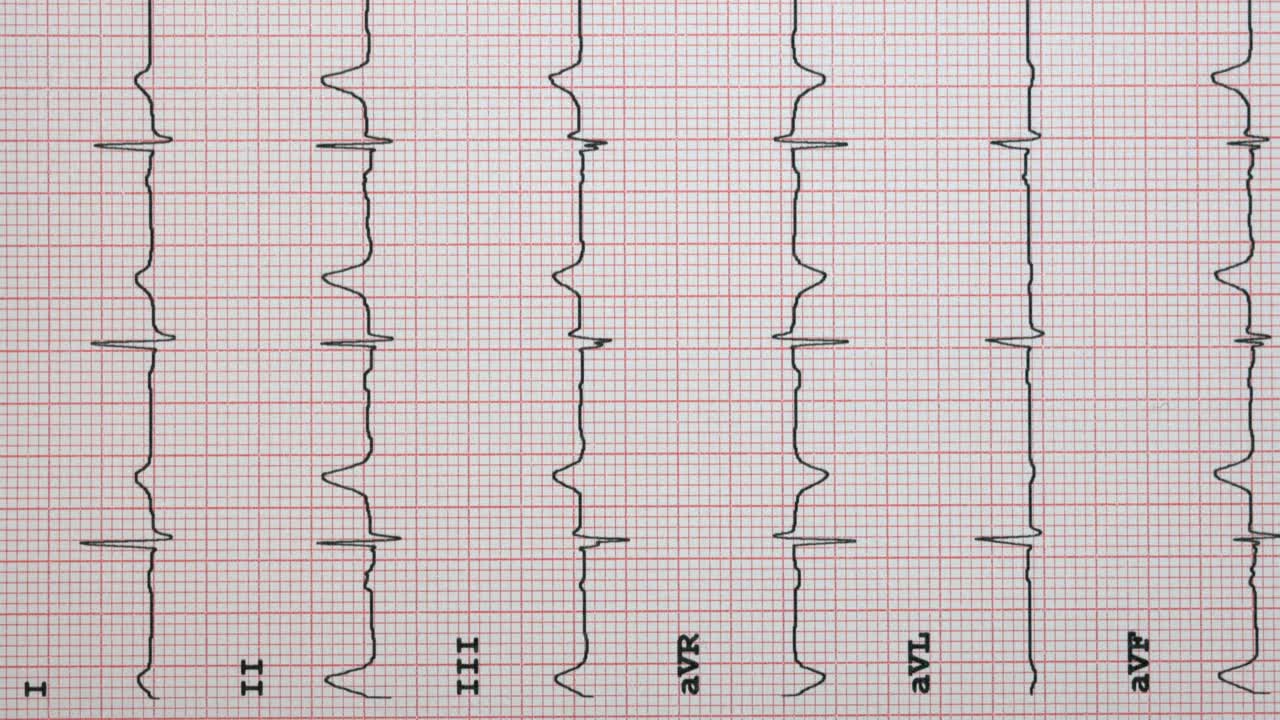 心电图显示窦性心律正常，四肢导联视频素材