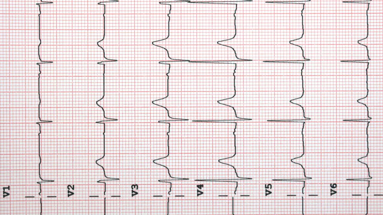 心电图显示窦性心律正常，心前导联正常视频下载