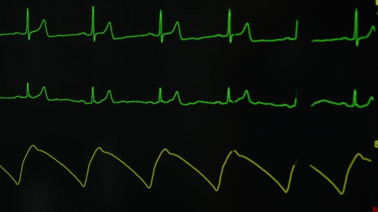 在电脑屏幕上监测生命体征视频素材