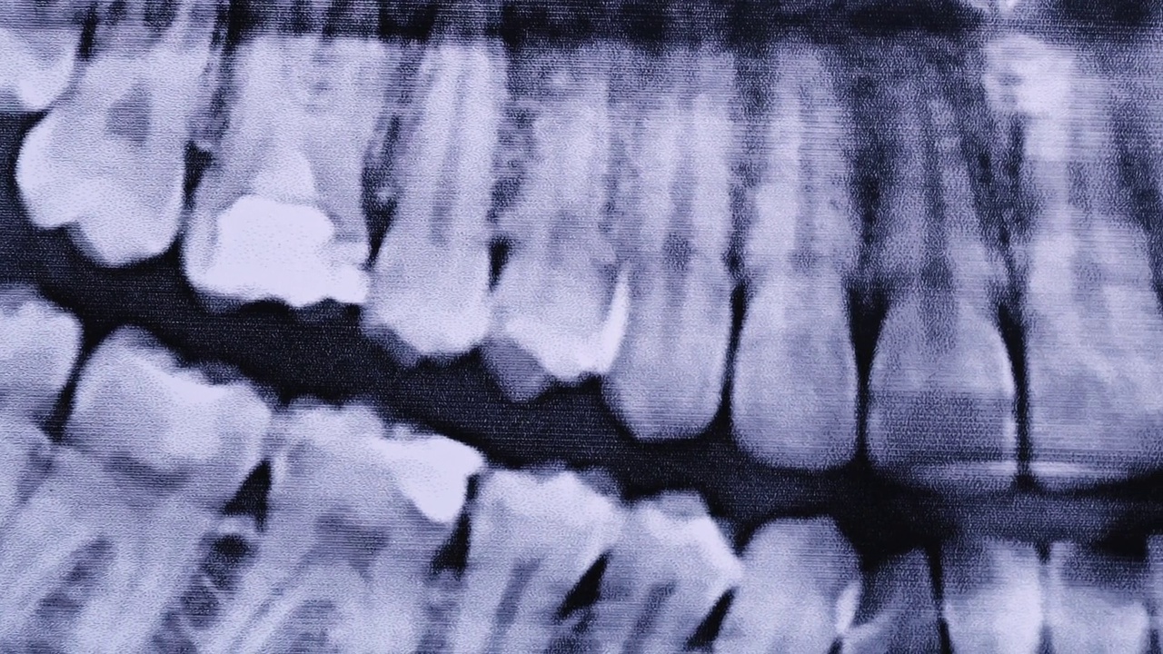 所有人类牙齿颌部的x射线图像特写视频素材