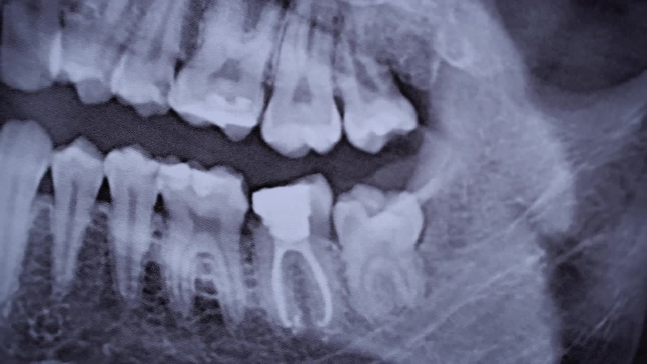 所有人类牙齿颌部的x射线图像特写视频素材