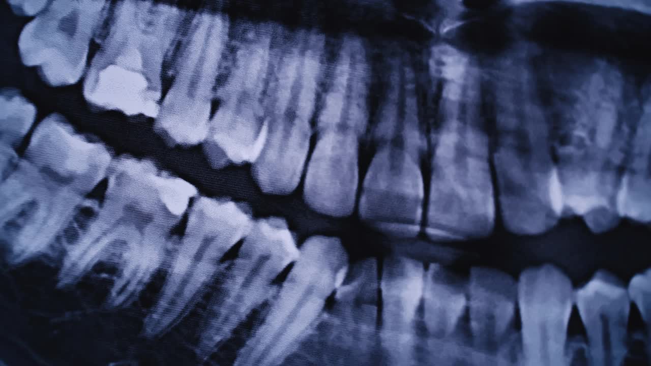 所有人类牙齿颌部的x射线图像特写视频素材