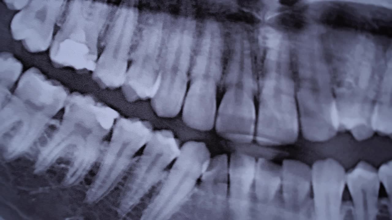 所有人类牙齿颌部的x射线图像特写视频素材