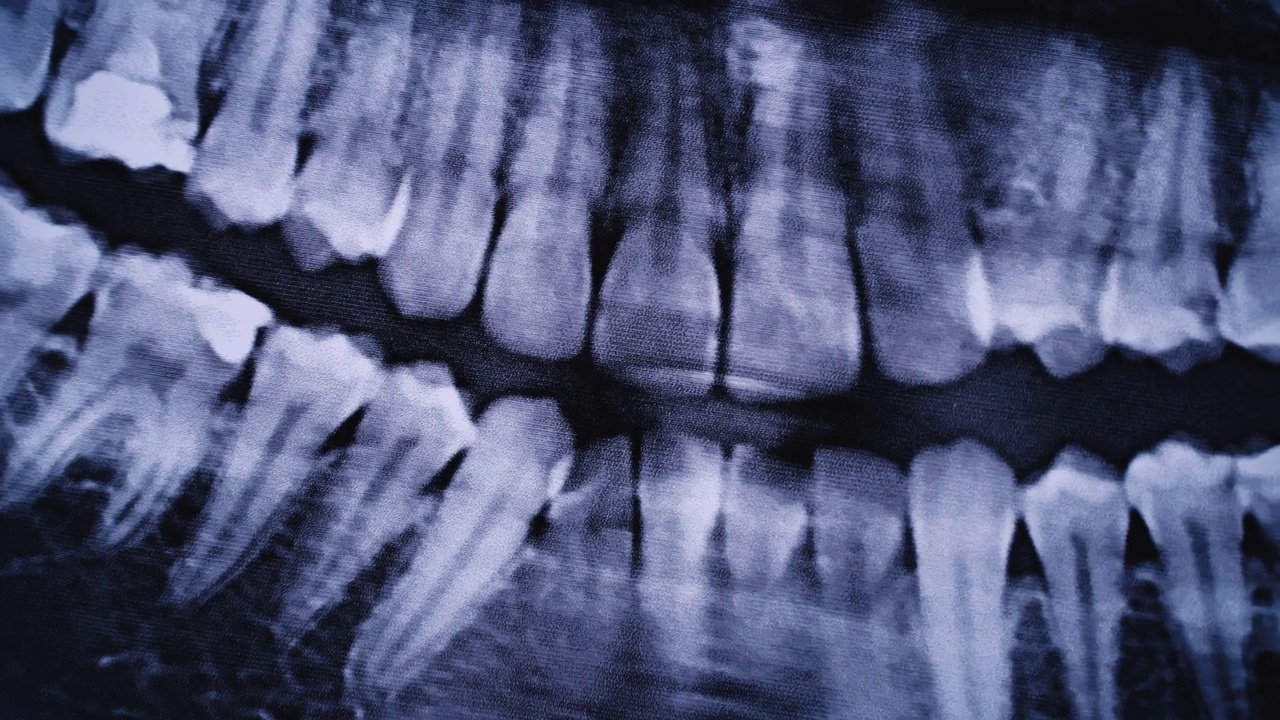 所有人类牙齿颌部的x射线图像特写视频素材