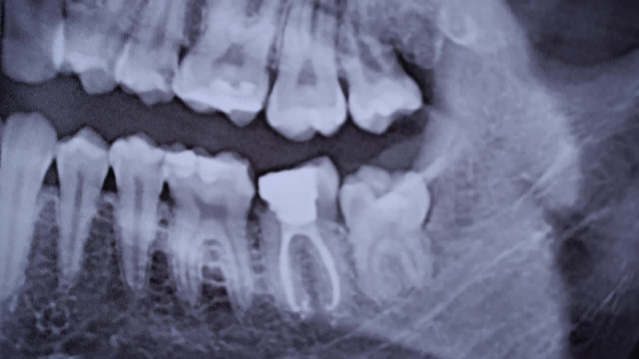 所有人类牙齿颌部的x射线图像特写视频素材