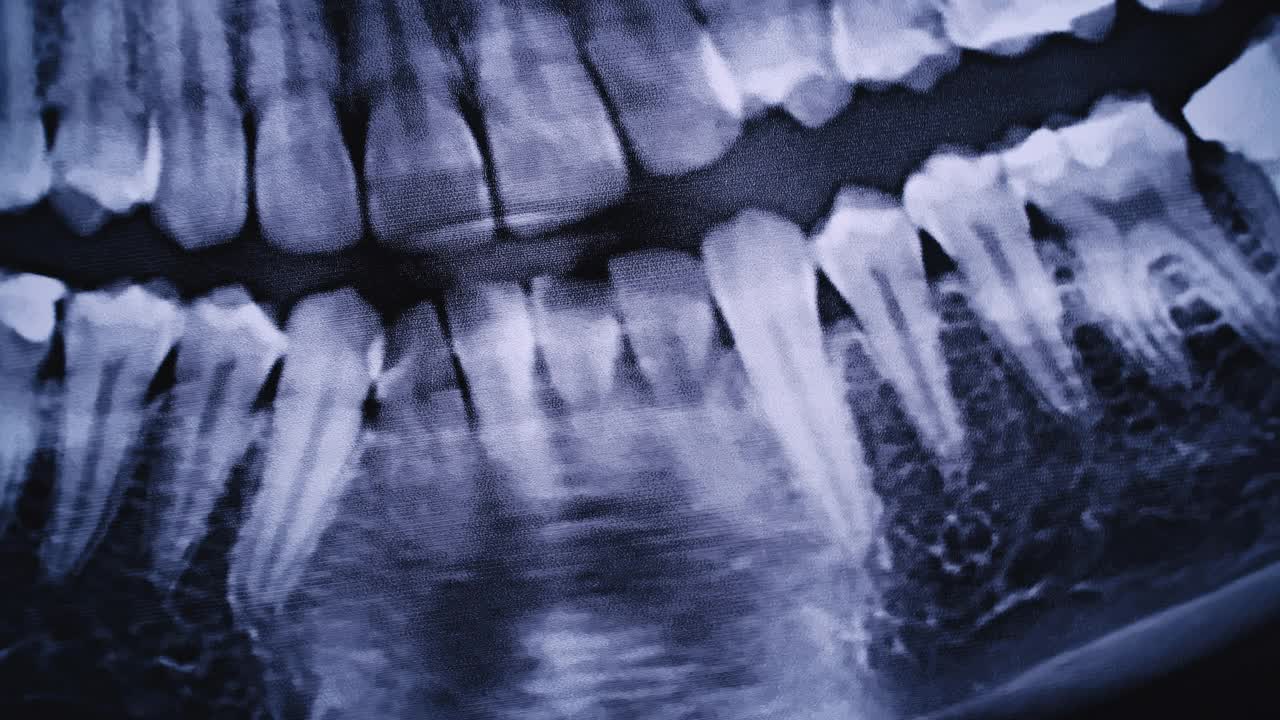 所有人类牙齿颌部的x射线图像特写视频素材