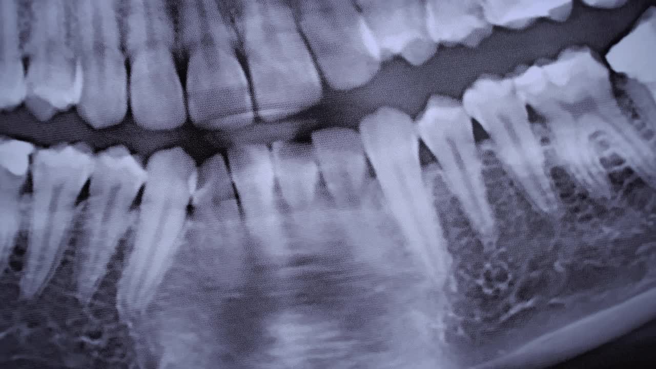 所有人类牙齿颌部的x射线图像特写视频素材
