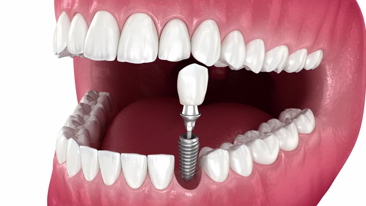 牙种植体和陶瓷冠安置。医学上精确的牙齿3d动画视频素材