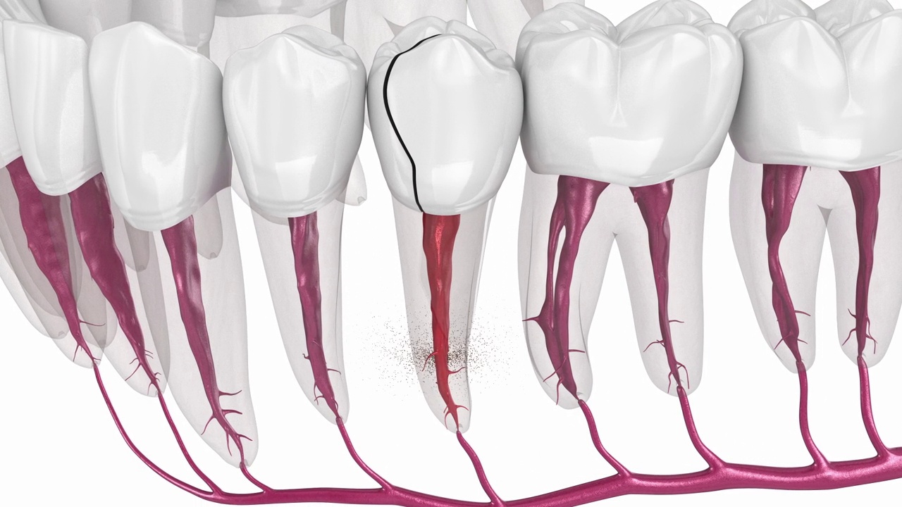 牙齿裂开了。医学上精确的3D动画视频下载