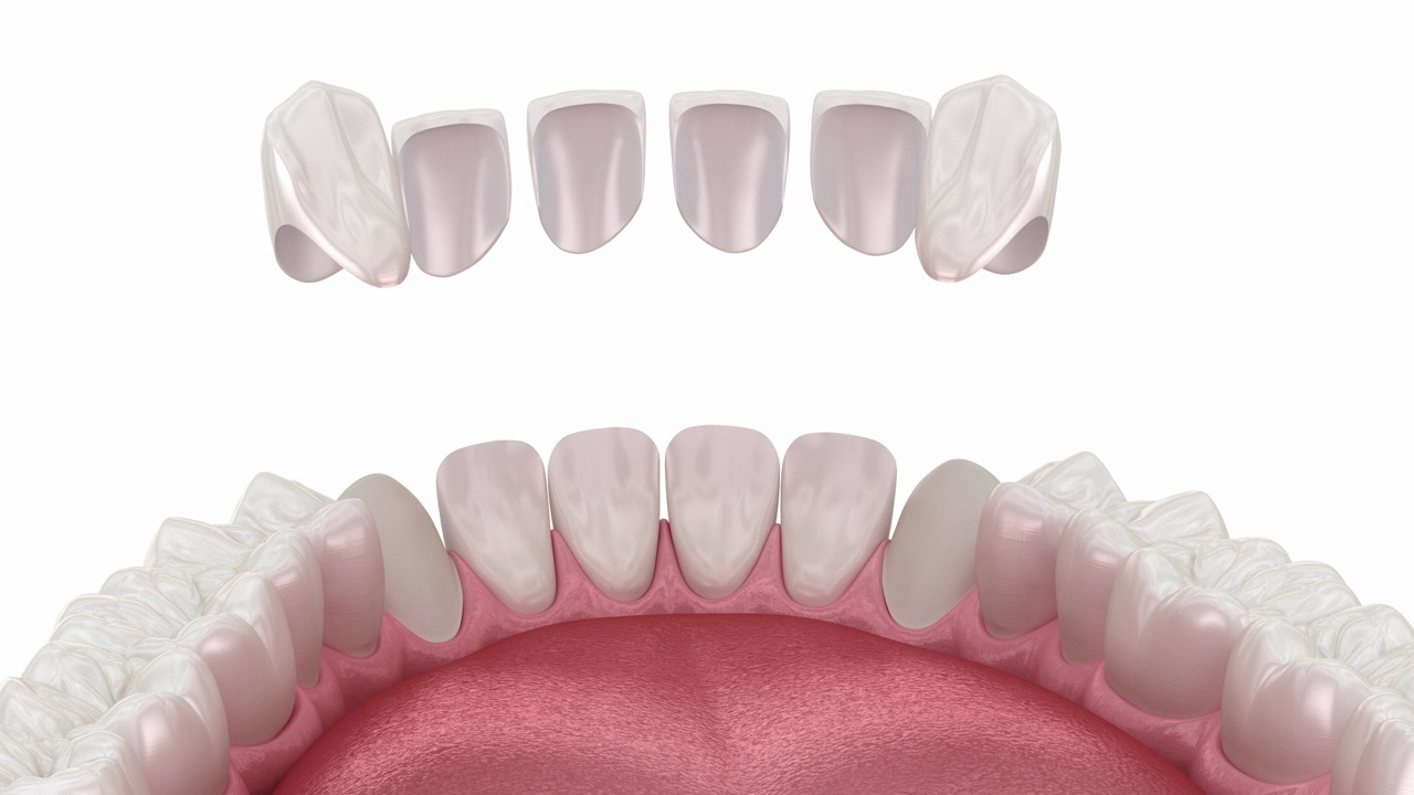 牙贴面放置程序。牙科3D动画视频素材
