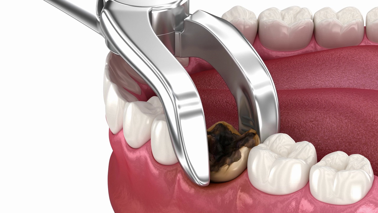 拔除受损牙齿。牙科3D动画视频下载